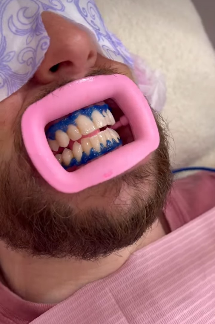 Whitening gel applied over teeth with a lip retractor in place